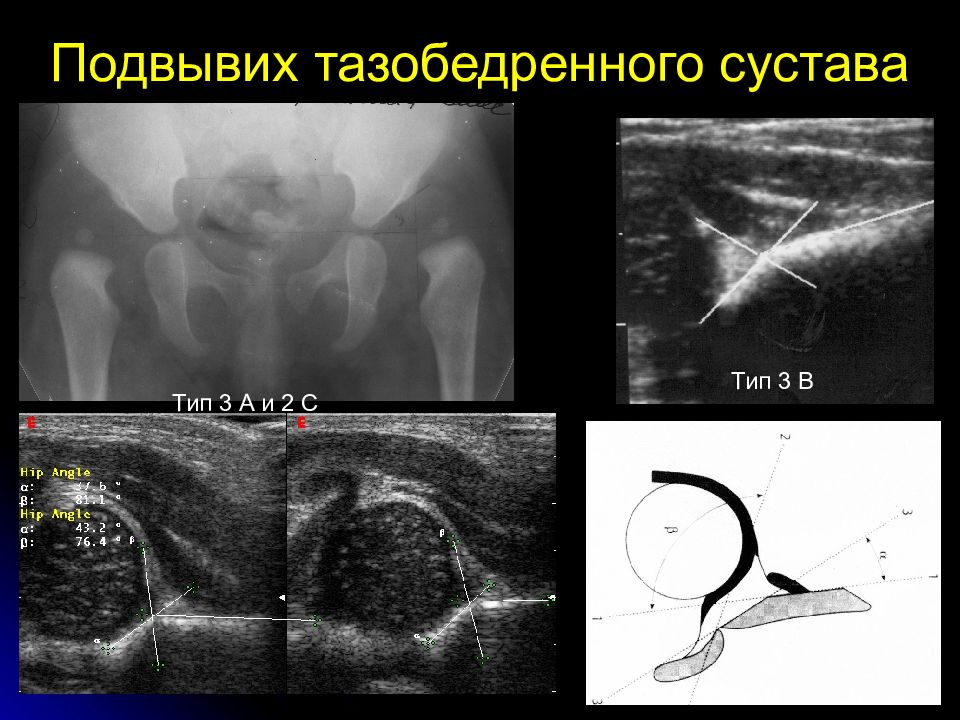 Узи тазобедренного. УЗИ ТБС дисплазия углы. Дисплазия тазобедренных суставов УЗИ. Дисплазия тазобедренных суставов у детей УЗИ. УЗИ тазобедренных суставов по графу норма.