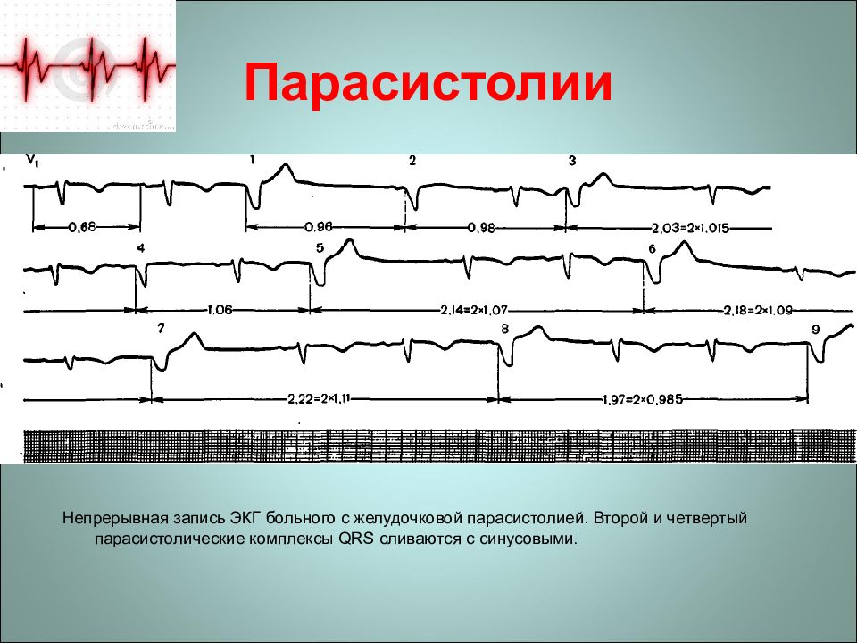 Как выглядит экстрасистолия на экг фото