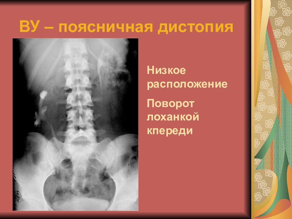 Дистопия почки. Подвздошная дистопия почки рентген. Дистопия почки рентген. Каудальная дистопия почки. Подвздошная/поясничная дистопия.