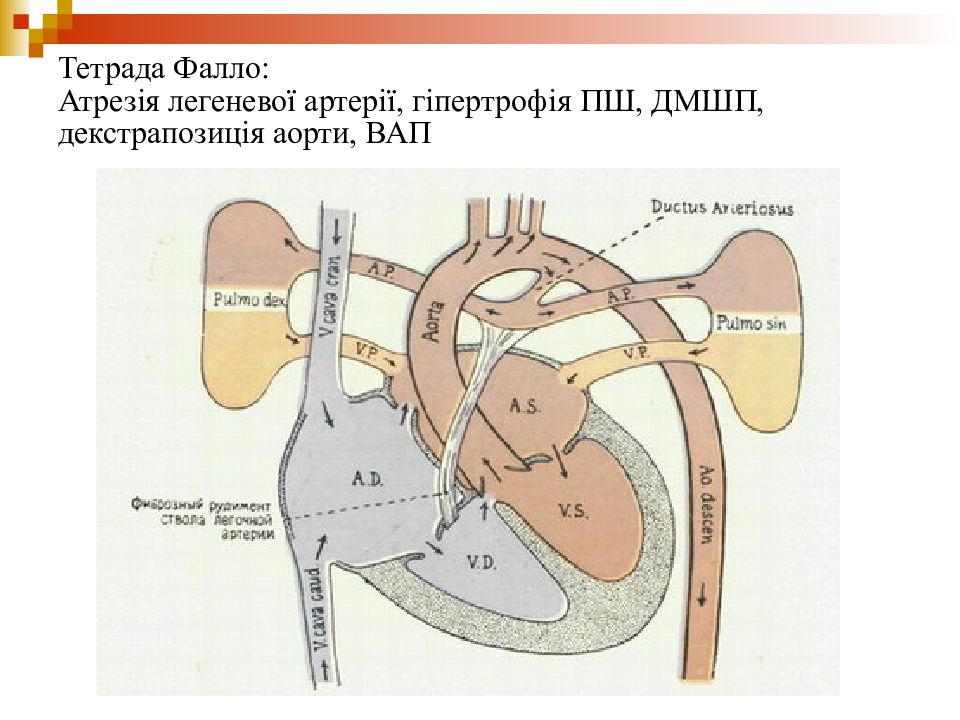 Легочный рисунок при тетраде фалло