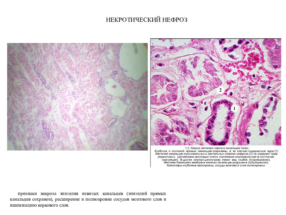 Нефроз. Макропрепарат некроза эпителия почки. Патанатомия гистология некроз канальцев.