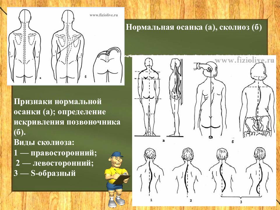 Признаки нормального человека. Сколиотическая осанка. Искривление осанки сколиоз. Методы исследования сколиоза. Нормальная осанка и сколиоз.