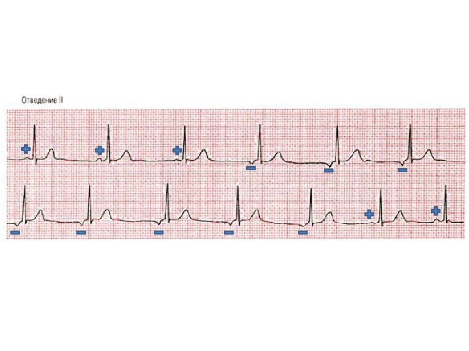 Миграция водителя ритма на экг. ЭКГ диаграмма. Цвета ECG. Гистограмма ЭКГ. Диаграмма ЭКГ Графика.