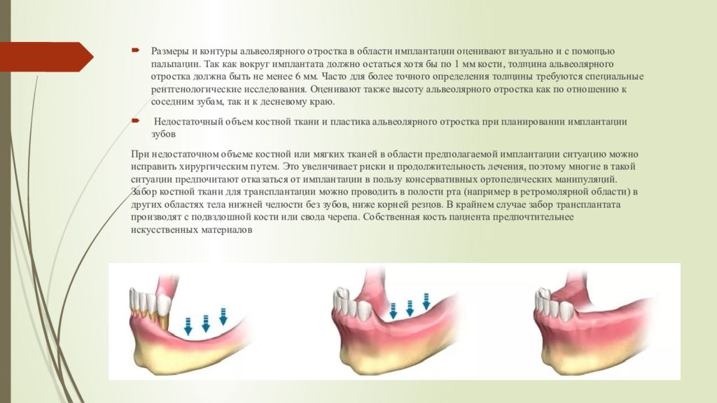 Что нельзя после имплантации. Коррекция альвеолярного отростка. Коррекция формы альвеолярного отростка. Коррекция объема и формы альвеолярного отростка. Альвеолярной костной ткани.