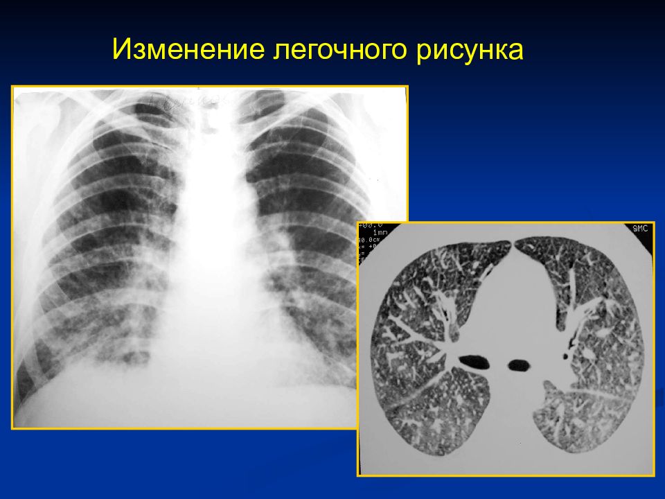 Типы легочного рисунка. Бактериальная пневмония рентген. Изменение легочного рисунка. Изменение легочного рисунка на рентгенограмме. Патологические изменения легочного рисунка.