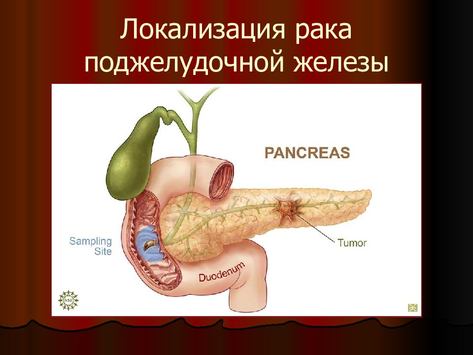 Синдром золлингера эллисона картинки