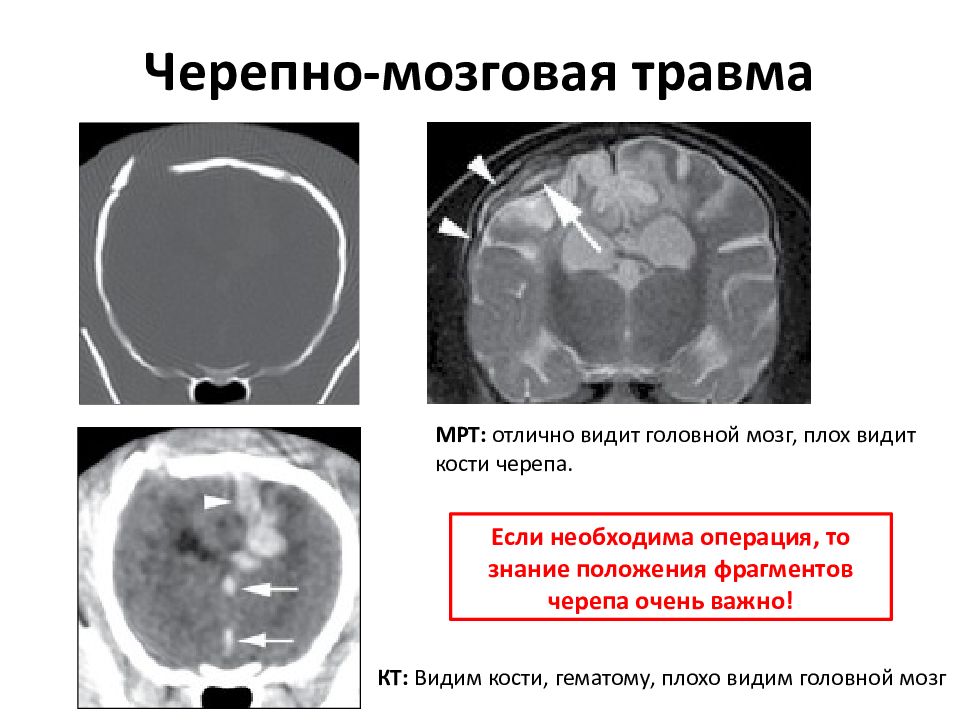 Сотрясение мозга рентген покажет. Черепно-мозговая травма кт. Мрт головного мозга при ЧМТ. Кт головного мозга при ЧМТ. Черепно мозговая травма кт и мрт.