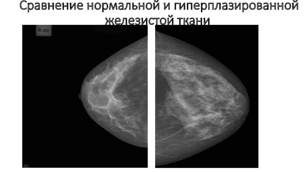 Маммография — презентация
