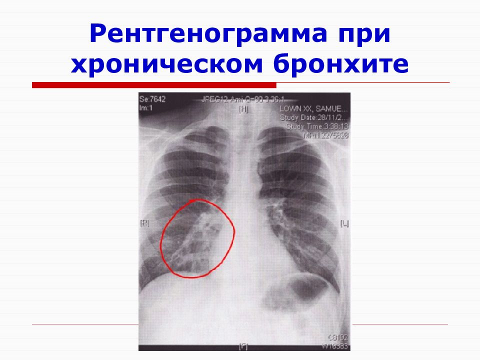 Рентгенограмма это. Хронический бронхит рентгенограмма. Пневмония презентация. Рентгенография при хроническом бронхите. Рентгенография при остром бронхите.