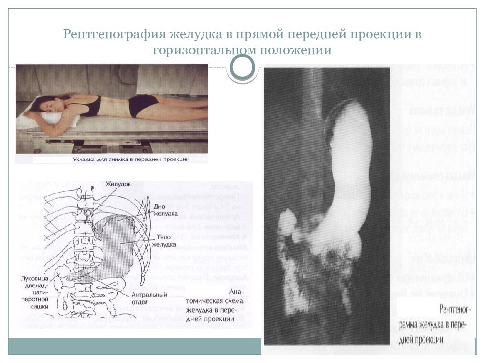 Проекции рентгенографии. Положение Тренделенбурга при рентгенографии пищевода и желудка. Рентген пищевода в положении Тренделенбурга. Рентгеноскопия желудка в положении Тренделенбурга. Проекции пищевода на рентгене.