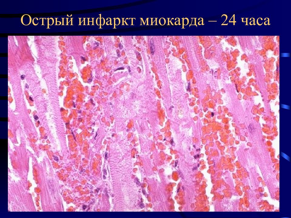 Ибс патологическая анатомия презентация