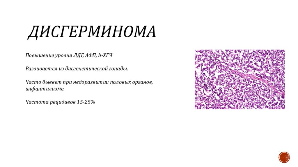 Дисгерминомы яичника. Дисгерминома яичника гистология. Дисгерминома яичников это. Неэпителиальная опухоль яичника.