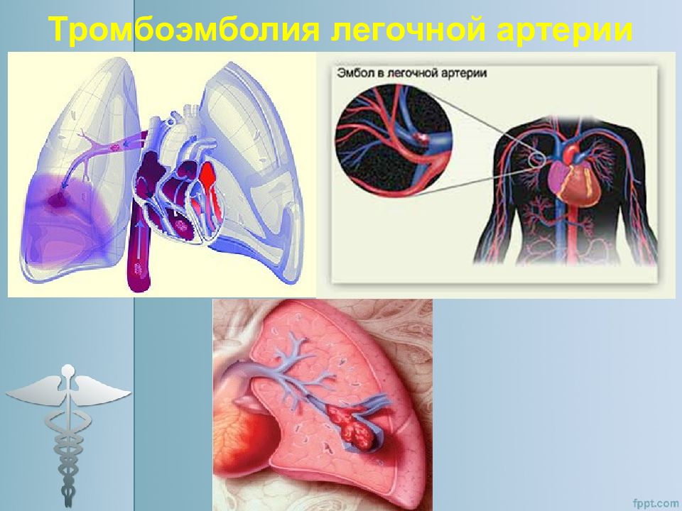 Острая тромбоэмболия легочной. Тэла патофизиология. Тромбоэмболия артерии. Тромбоэмболия легочной артерии. Легочная артерия.