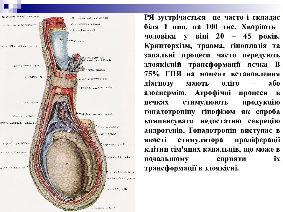 Рак яичка презентация