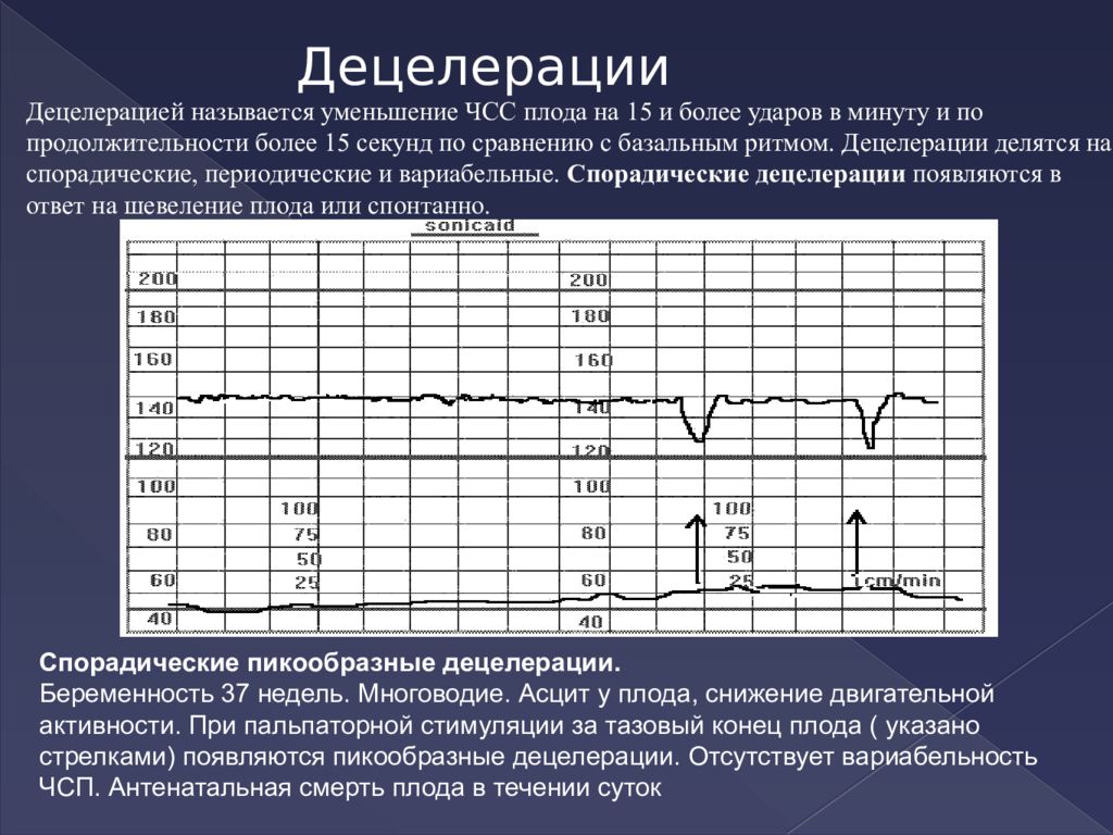 Уменьшение частоты. Кардиотокография плода презентация. Децелерация на КТГ. Вариабельные децелерации на КТГ. Базальная частота сердечных сокращений плода.