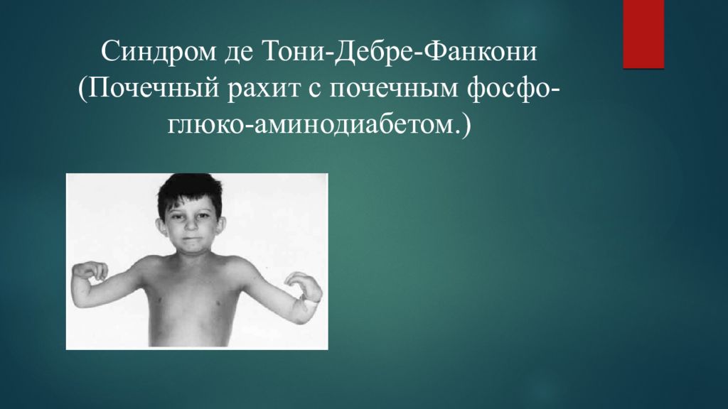 Синдром де Тони-Дебре- Фанкони (Почечный рахит с почечным фосфо-глюко-аминодиабетом.)