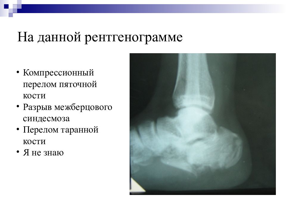 Перелом пяточной кости карта вызова