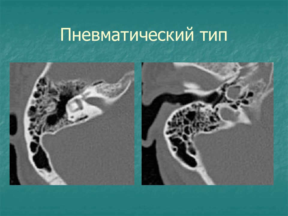 Средний отит кт картина