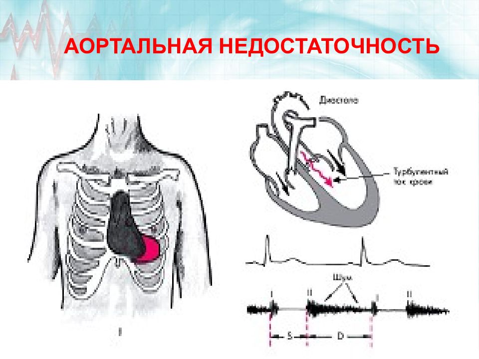 Аортальная недостаточность презентация