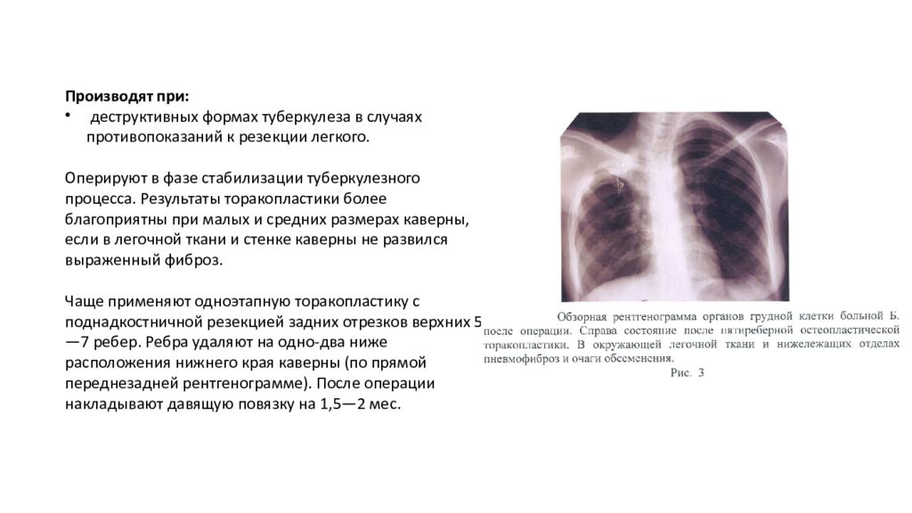 Оперативное лечение туберкулеза