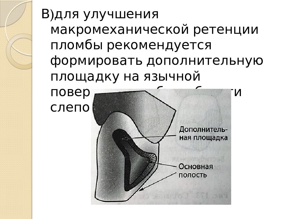 Дополнительные площадки кариозной полости. Дополнительная площадка 3 класс по Блэку. Препарирование полостей 4 класса по Блэку. Этапы препарирования кариозной полости IV класса. Полость 4 класса по Блэку.