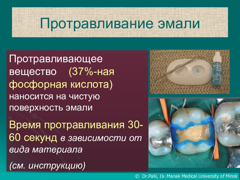 Полость применять. Протравливание эмали кислотой. Протравливание эмали зуба. Фосфорная кислота в стоматологии.