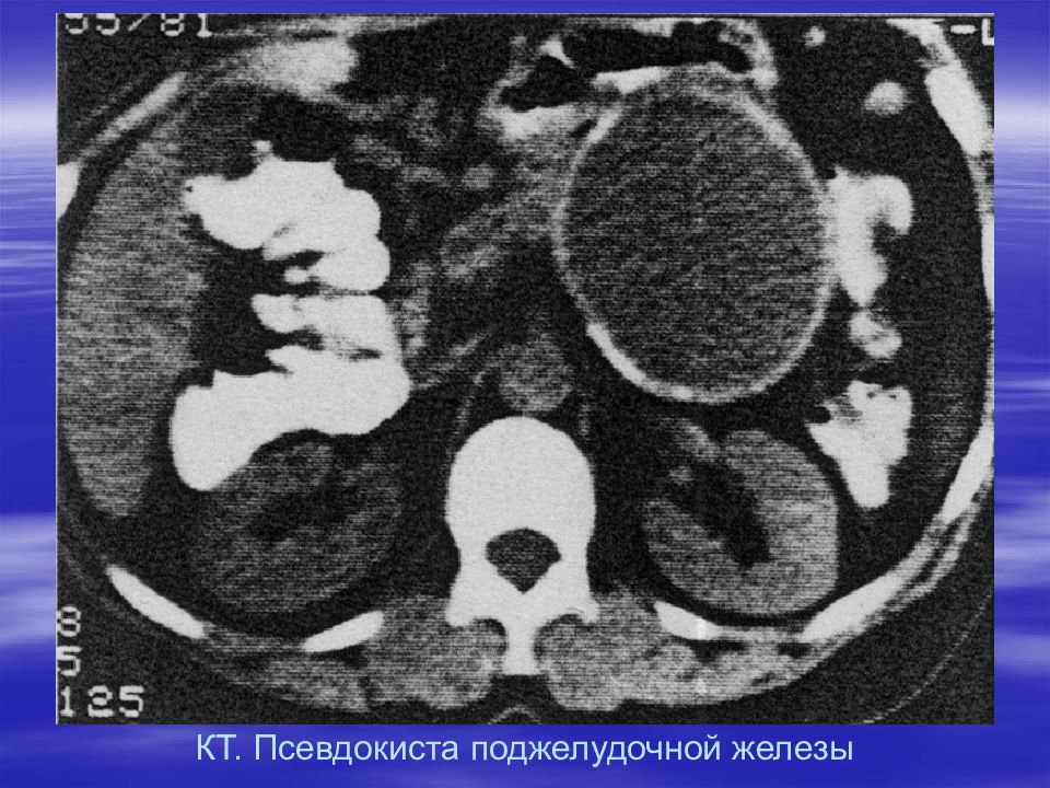 Псевдокиста поджелудочной железы. Острый панкреатит псевдокиста. Псевдокиста поджелудочной кт. Псевдокисты поджелудочной железы на кт. Псевдокиста поджелудочной железы кт.