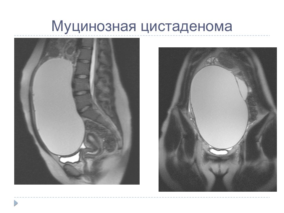 Серозная цистаденома. Муцинозная цистаденома. Серозная цистаденома мрт. Папиллярная цистаденома мрт.