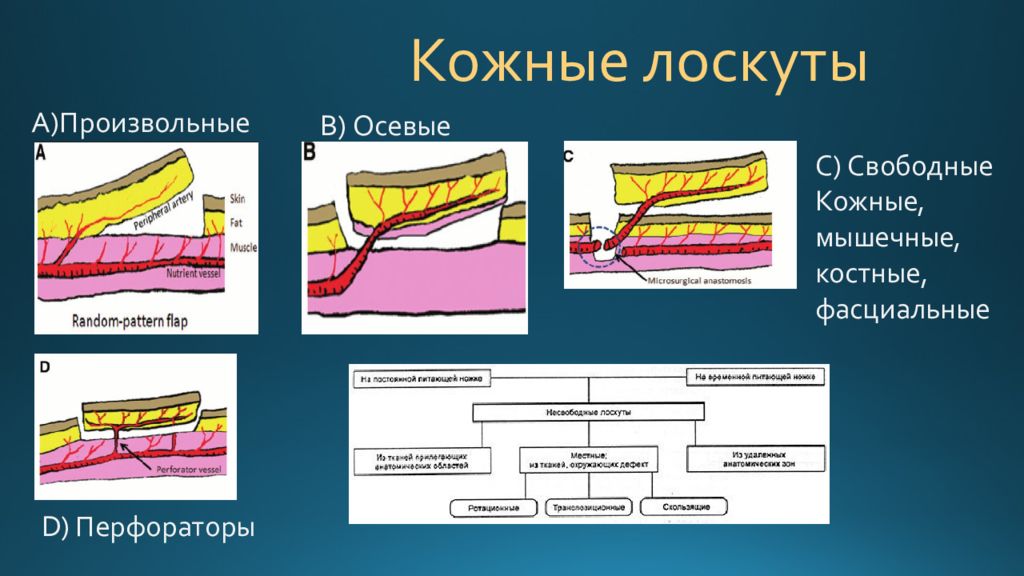 Кожная пластика кожным лоскутом. Лоскут кожно-мышечно-костный.