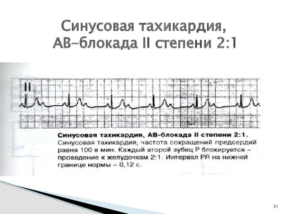 Синусовая тахикардия. АВ блокада 1 степени ЭКГ ритм синусовый. Предсердная тахикардия с АВ блокадой 2:1. Атриовентрикулярная блокада 2 степени ЧСС. АВ блокада 2 1 при синусовой тахикардии.