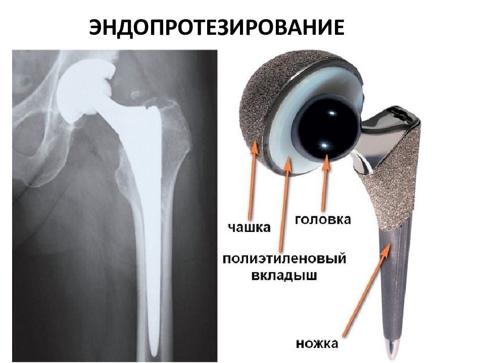 Замена эндопротезов