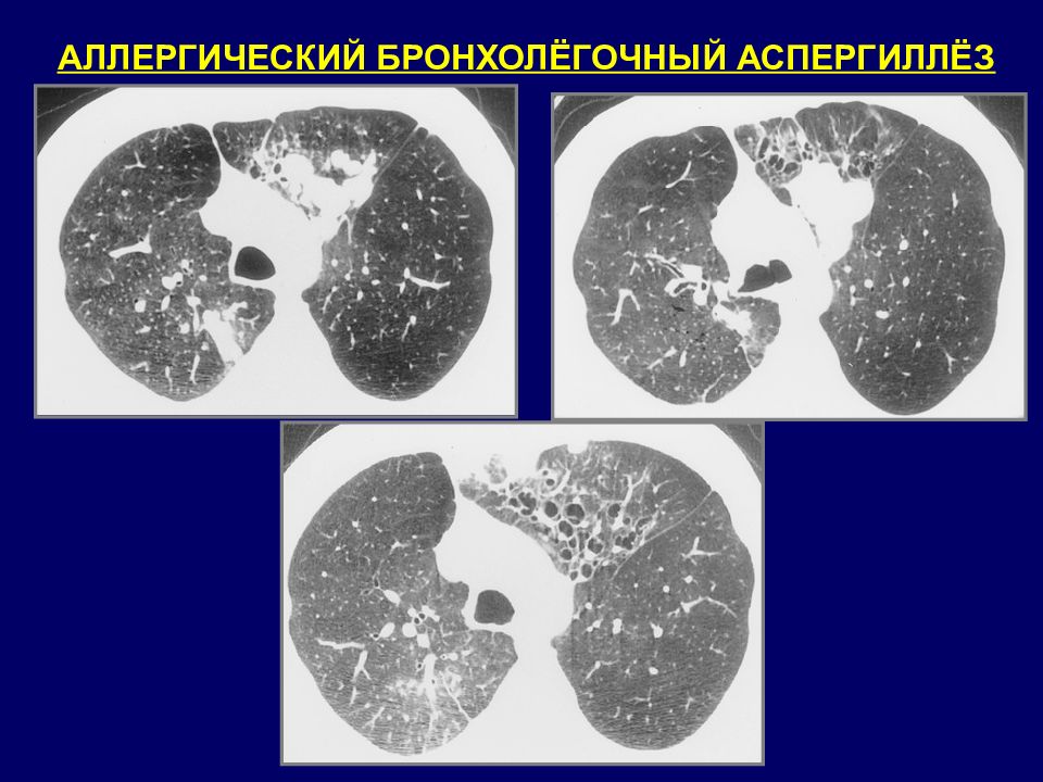 Аспергиллез кт картина