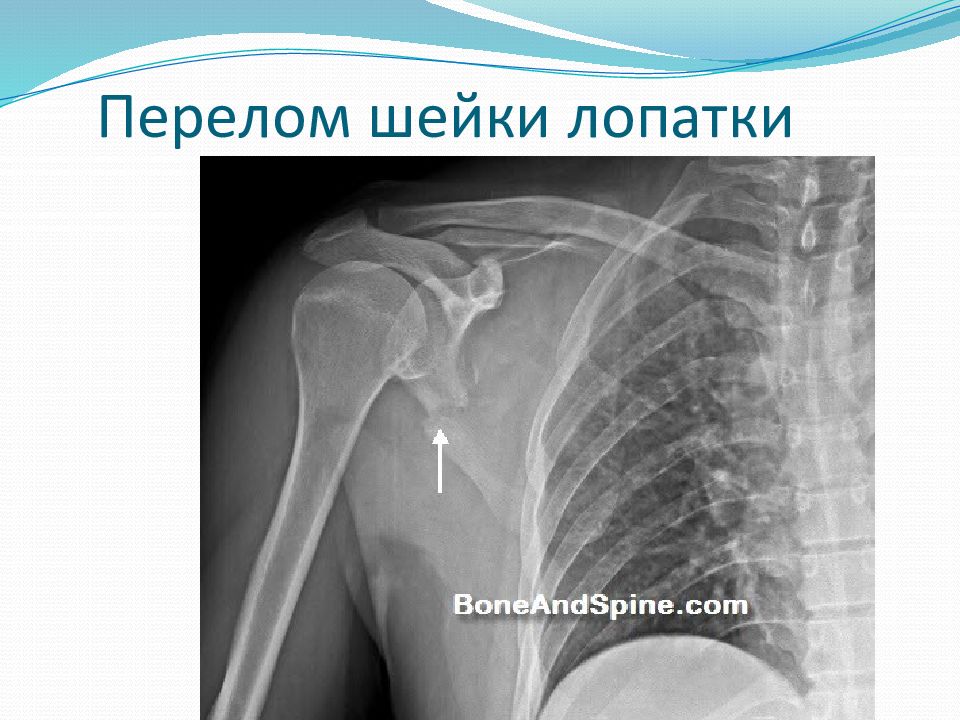 Картинки перелом лопатки