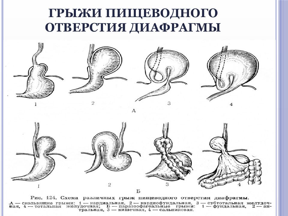 Грыжи пищеводного отверстия диафрагмы презентация по хирургии