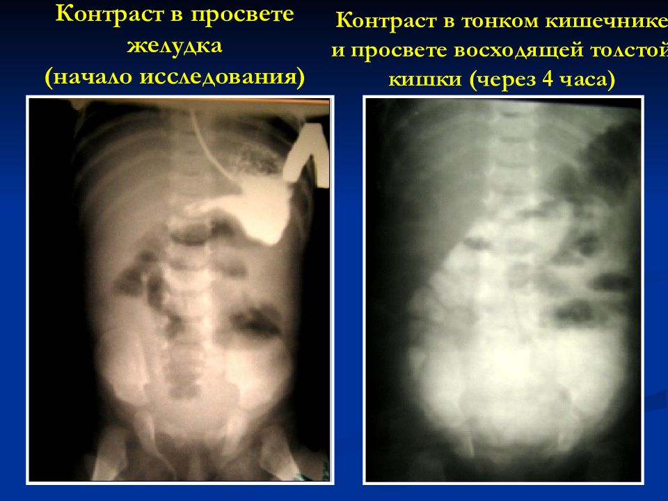 Контрастирование тонкой кишки. Спаечная кишечная непроходимость у детей. Острая спаечная кишечная непроходимость. Кишечная непроходимость фото человек. Отличие ранней и поздней спаечной непроходимости у детей.