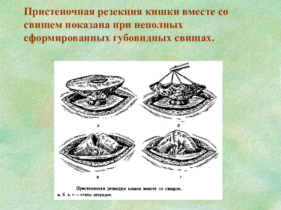 Сформированные свищи. Губовидный кишечный свищ. Сформированные и несформированные кишечные свищи. Неполный губовидный свищ. Тонкокишечный свищ после операции.