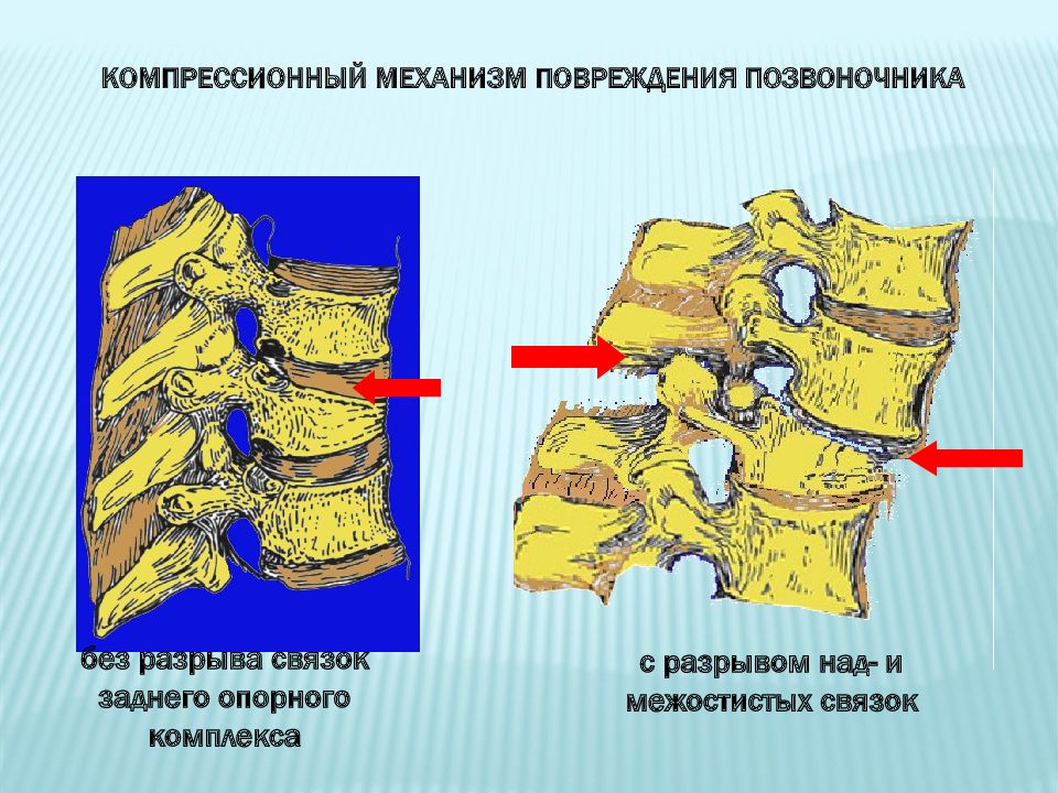 Повреждение. Компрессионный перелом позвоночника механизм. Механизм компрессионного перелома позвонка. Компрессионный перелом позвоночника 1с 8. Механизм компрессионного перелома тел позвонков.