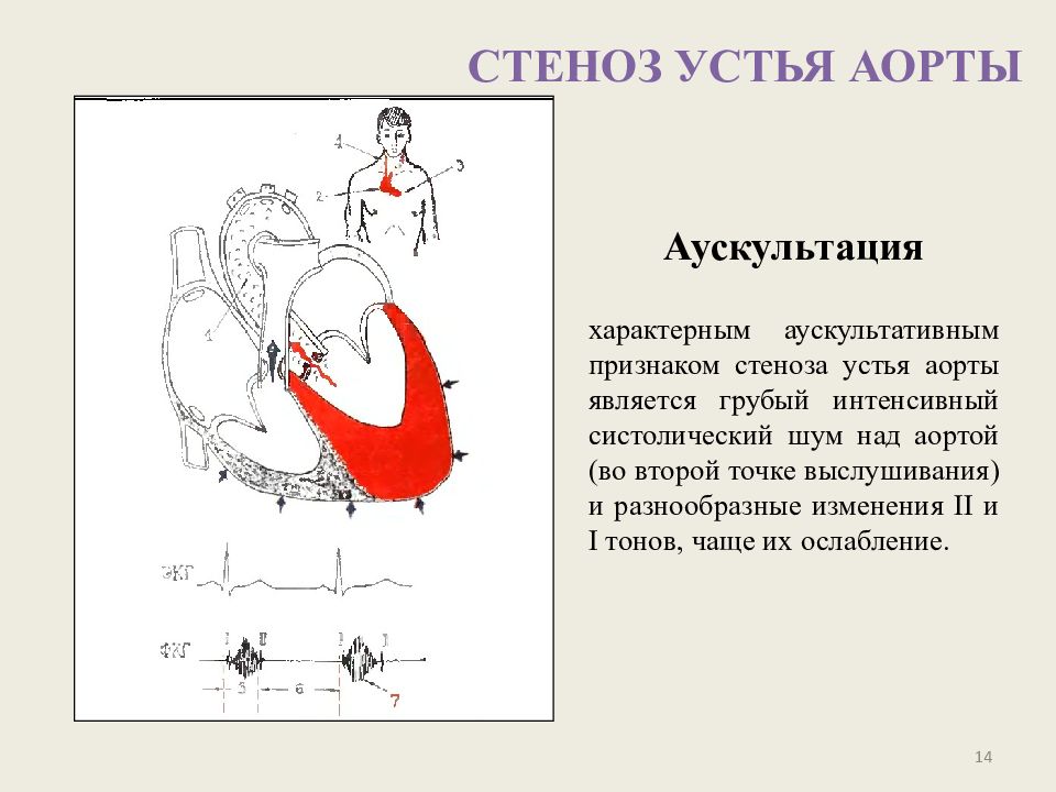 Аорта выслушивается. Аускультация при аортальном стенозе. Аускультация при стенозе аорты. Стеноз устья аорты аускультация. Стеноз устья аорты аускультативная картина.