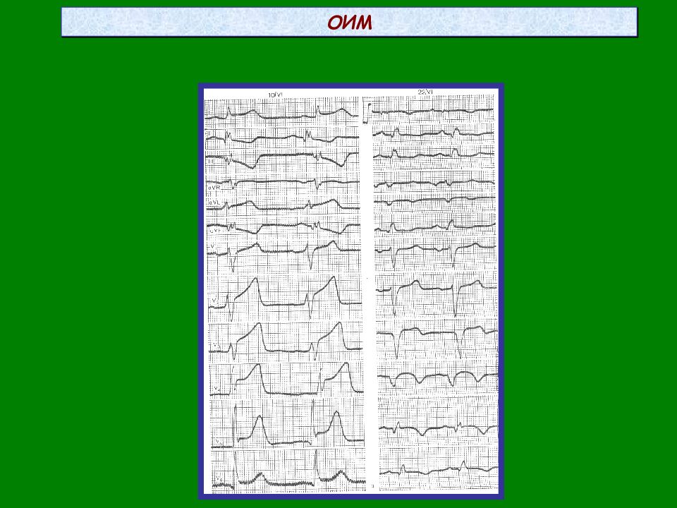 Экг при остром. ЭКГ при инфаркте миокарда. ОИМ топика ЭКГ. Лутра а. "ЭКГ понятным языком".