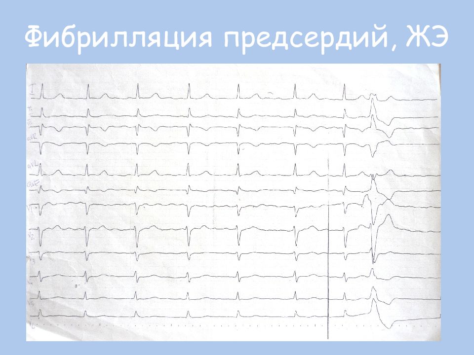 брадисистолическая фибрилляция предсердий