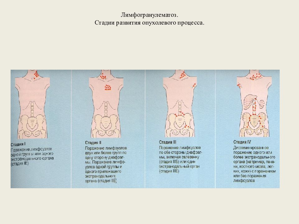 Стадии лимфом. Лимфогранулематоз классификация. Стадии лимфогранулематоза. Лимфогранулематоз стадии развития. Клинические стадии лимфогранулематоза.