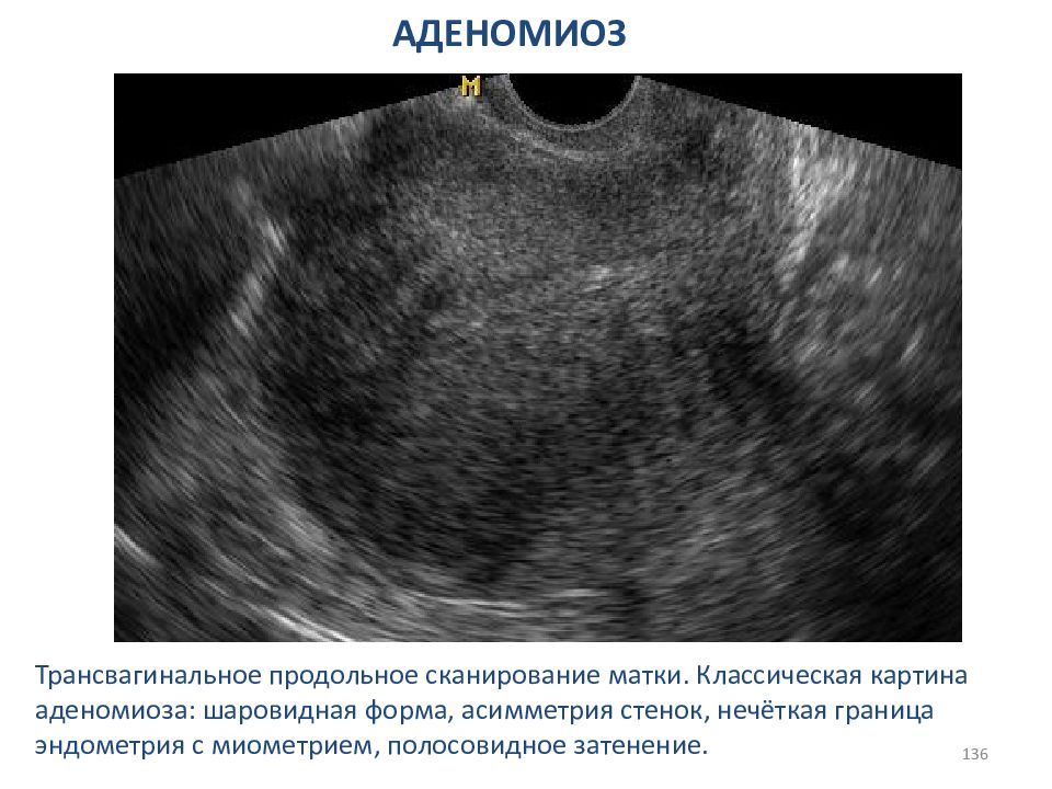 Эндометрия стенок матки. Диффузно Узловой аденомиоз УЗИ матки.