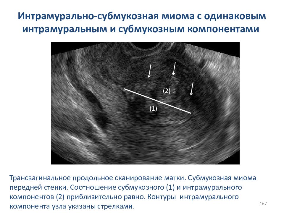 Интрамуральная лейомиома матки что это означает. Интрамурально субмукозный. Миома матки субмукозный.
