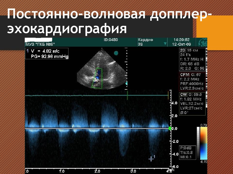 Эхокардиография сердца презентация