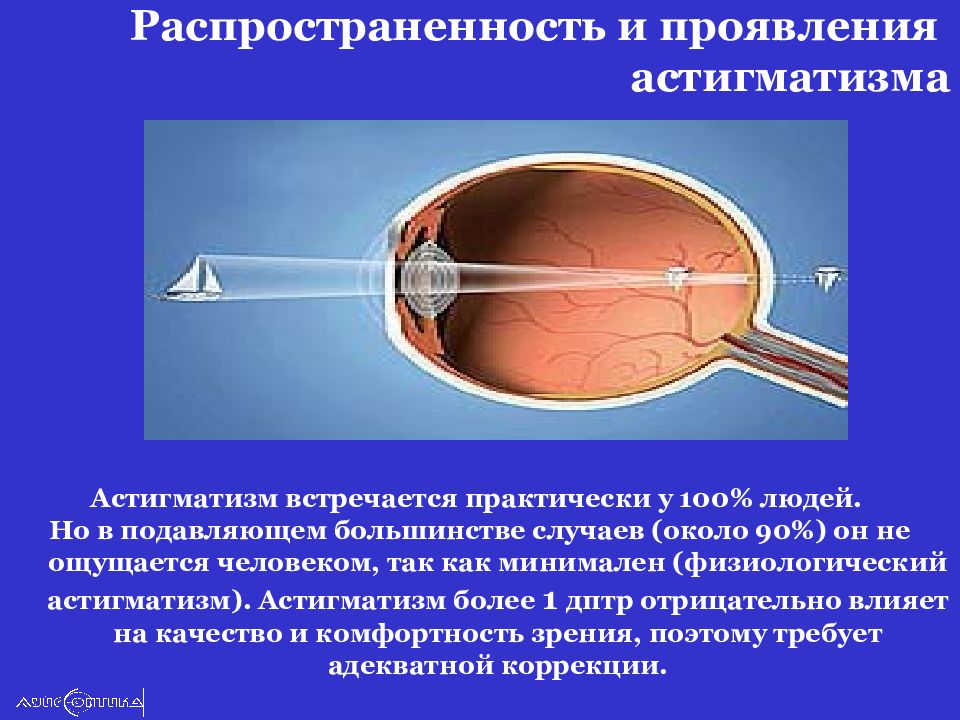 Астигматизм что это такое. Астигматизм. Астигматизм распространенность. Физиологический астигматизм. Астигматизм симптомы.