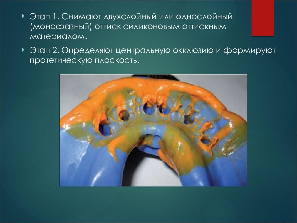 клинические этапы протезирования