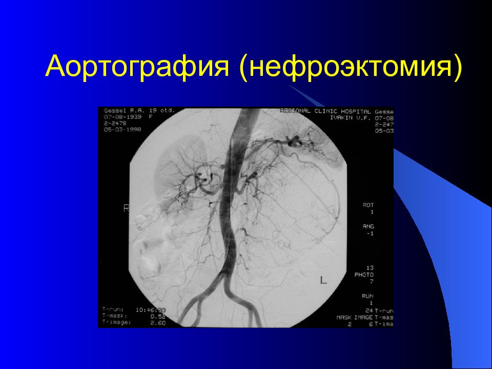 Нестенозирующий атеросклероз