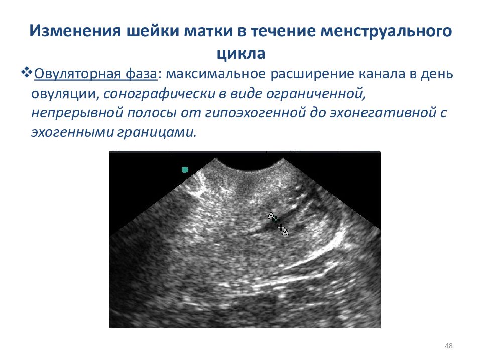 Эхогенный очаг в матке. Изменения в матке в течении менструального цикла. Структура эндометрия матки гипоэхогенный. Эхогенная прогрессирующая маточная беременность?.