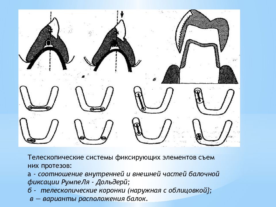 Презентация ортопедия коронки