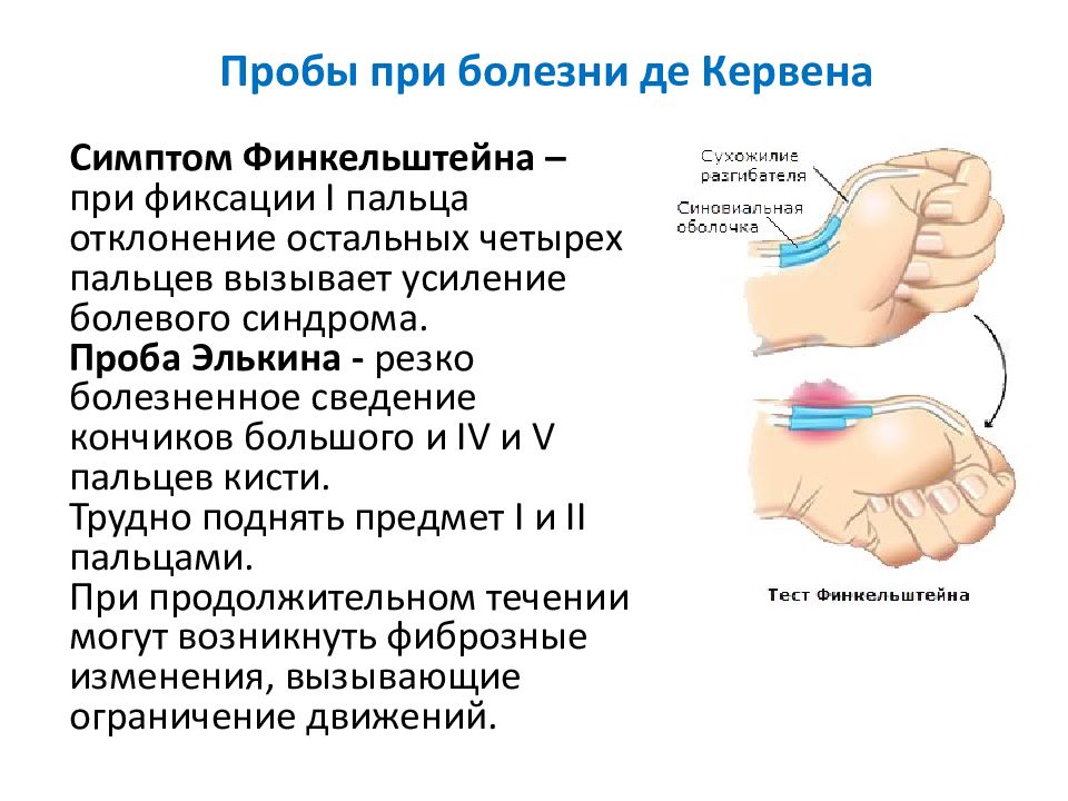 Болезнь де кервена. Синдром компьютерной мыши болезнь де Кервена. Тендовагинит де Кервена кисти. Симптом Финкельштейна. Болезнь Нотта и де Кервена.